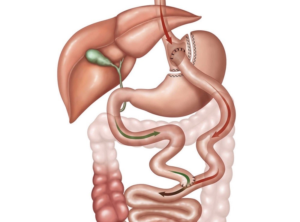 Без желудка после операции. Лапароскопическое шунтирование желудка (gastric-Bypass). Бариатрическая операция шунтирование желудка. Шунтирование желудка с анастомозом. Желудочное шунтирование схема операции.