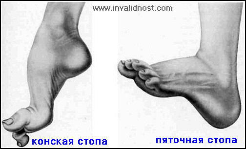 С ампутацией пальца ноги при сахарной диабете дают инвалидность